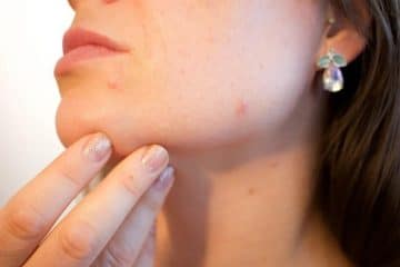 Why is My Skin Constantly Breaking Out?