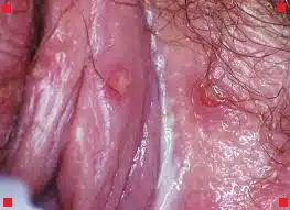 pimple-like bump on clitoral hood