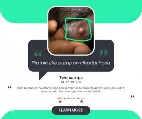 pimple like bump on clitorial hood