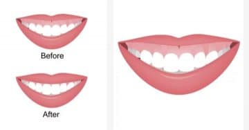 Gummy Smile