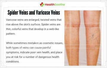 6 Things You Should Know About Spider Veins and Varicose Veins
