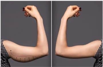 The top 4 reasons that you should consider liposuction surgery instead of just exercise and dieting!