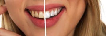 Teeth, Dental Care, White, White Teeth, Hygiene