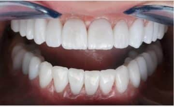 Everything You Need to Know About Bridge Dentistry 