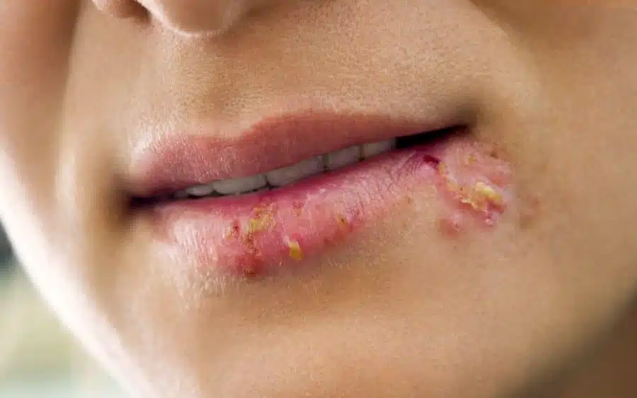 Herpes on the lips of the young woman
