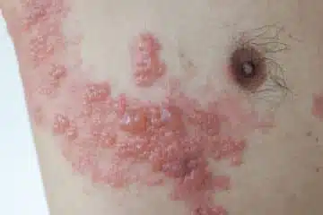Herpes 101: 6 Things You Need To Know Herpes zoster