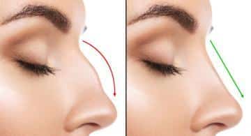 How to recovery from nose surgery quickly