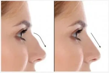 Reshaping Your Nose Without Surgery: The Benefits of Nonsurgical Rhinoplasty