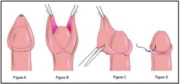 4 Weeks After Circumcision Pictures penis circumcision in stages