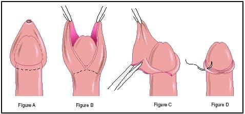 penis circumcision in stages