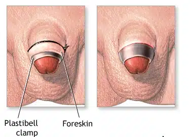penis circumcision - weeks after circumcision pictures