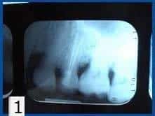 what tooth cavity looks like on x-ray