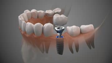 Dental Implants Mississauga: 6 Reasons To Get Yours Done