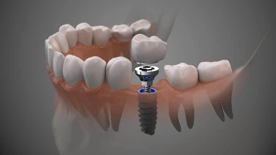 4 Dental Implant Statistics You Need To Know 