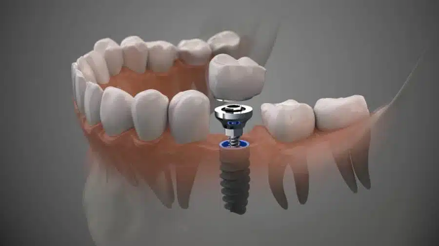 4 Dental Implant Statistics You Need To Know 