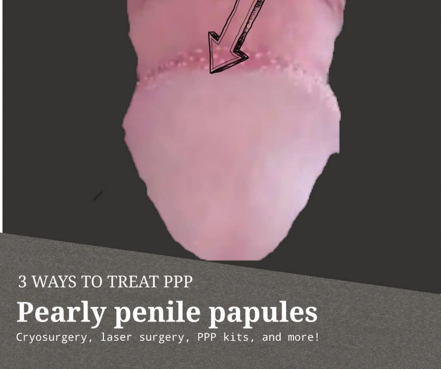 3 ways to treat PPP ( PEARLY PENILE PAPULES)