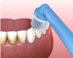 Dental cleaning