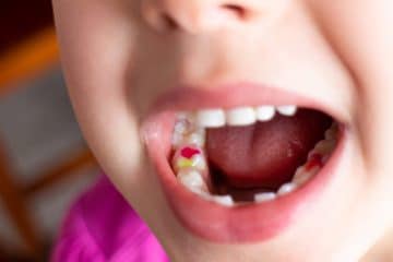 Toddler Tooth Decay: 5 Signs And Solutions