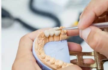 Dental Bridges: Preparing for Your Initial Consultation