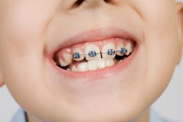 Tips For Finding A Hospital For Your Child Dental Braces Procedure