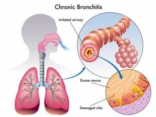 9 Ways to Prevent Acute and Chronic Bronchitis