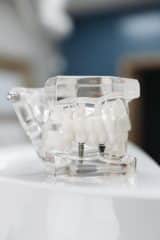 How Do You Prepare For Dental Implant Work