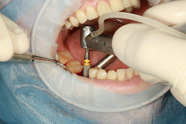 How Do You Prepare For Dental Implant Work