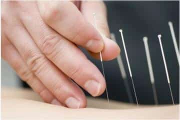 Everything You Need to Know About Acupuncture