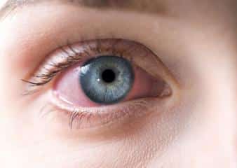 6 Ways To Soothe Eye Redness And Irritation