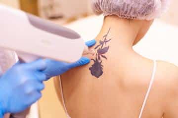 Top 4 Reasons To Consider Laser Tattoo Removal
