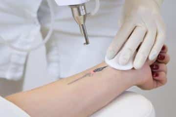 Laser Tattoo Removal