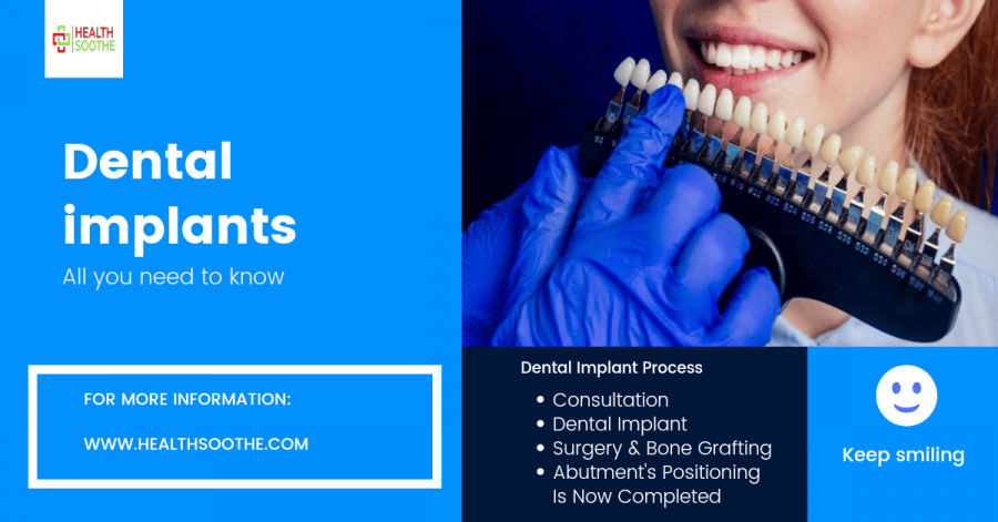 Dental Implants: All You Need To Know About It
