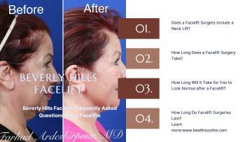 Beverly Hills Facelift: Frequently Asked Questions about Facelifts