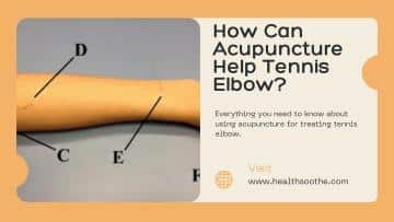 How Can Acupuncture Help Tennis Elbow?