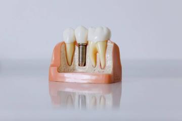 5 Health Benefits of Dental Implants