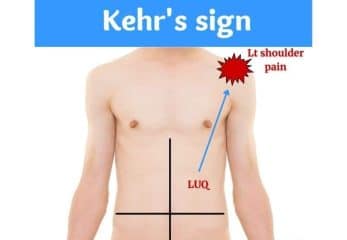 kehr's sign - Healthsoothe