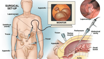 Treatment of appendicitis: Laparoscopic appendectomy - Healthsoothe
