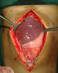 Treatment of appendicitis: Laparotomy - Healthsoothe