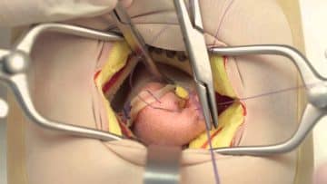 Treatment of appendicitis: Open appendectomy - Healthsoothe