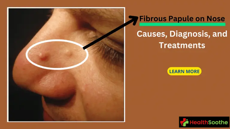 Fibrous papule on nose - Healthsoothe
