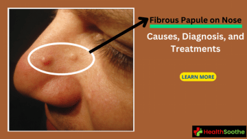 Fibrous papule on nose - Healthsoothe