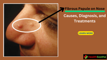 Fibrous Papule On Nose - Healthsoothe