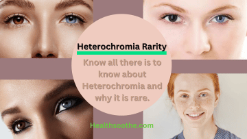 Heterochromia Rarity - Healthsoothe