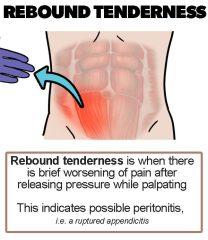 Diagnosing for appendicitis: rebound tenderness - Healthsoothe