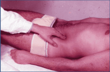 Diagnosing for appendicitis: Rovsing’s sign - Healthsoothe