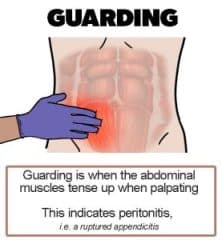 Diagnosing for appendicitis: guarding - Healthsoothe