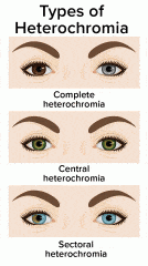 heterochromia rarity: Types of heterochromia - Healthsoothe