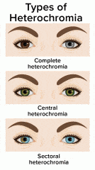 Heterochromia Rarity: Types Of Heterochromia - Healthsoothe