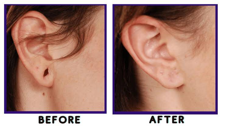 What Is Ear Reconstruction Surgery?
