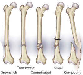 Long Bones Fracture - Healthsoothe